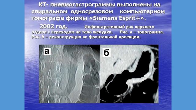 КТ пневмогастрография Введение газа в желудок при рентгеновском исследовании смотреть онлайн