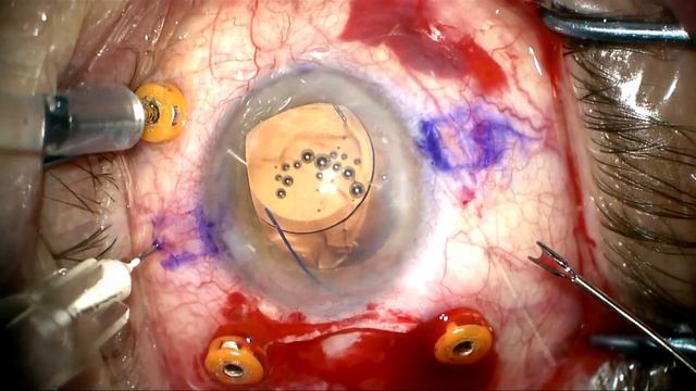PMMA IOL on retina removed/PPV/Yamane ISHF/ Goniotomy and iris repair by Steven G. Safran MD смотреть онлайн