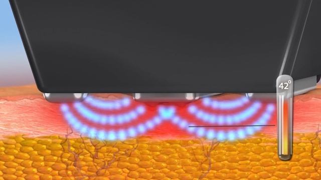 INMODE TERMOLIFTINGS FORMA смотреть онлайн