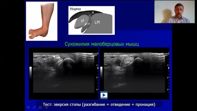 Мои пять советов по УЗИ стопы. смотреть онлайн
