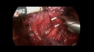 Лапароскопическая простатэктомия при больших размерах аденомы простаты