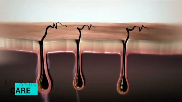 Лазерная эпиляция Бишкек смотреть онлайн