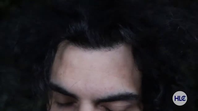 Результат пересадки 3600 волос мужчине - До и После - Спустя 10 месяцев - Клиника HLC смотреть онлайн