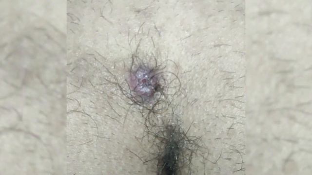 Дермоидная киста копчика смотреть онлайн