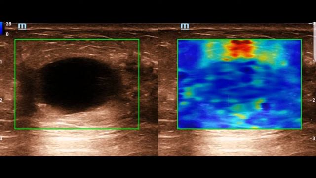 special cancer detection software. Simple breast cyst (Benign) смотреть онлайн