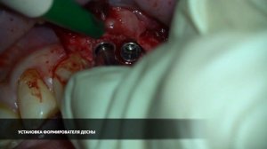 Установка формирователей десны на имплантаты Dentium