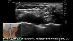 межлестничная блокада плечевого сплетения под контролем ультразвуковой визуализации