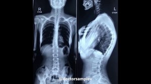 Лечение кифоза | Хирургическая коррекция кифотической деформации позвоночника