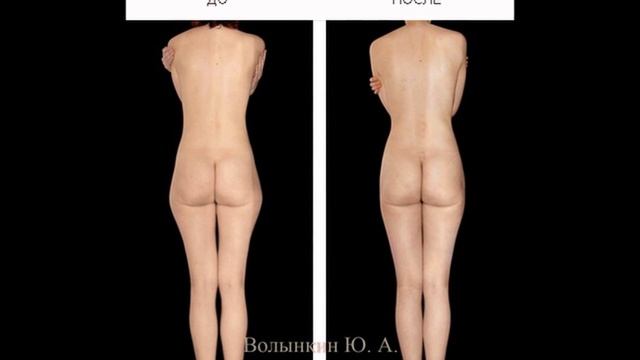 Что такое коррекция фигуры в Ручной Пластике®? смотреть онлайн