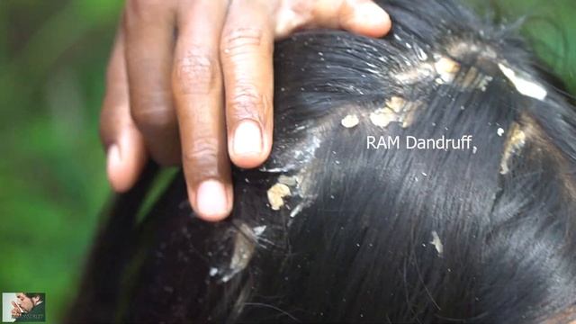 Psoriasis treatment - Big Flakes, Dandruff Scratching #139 смотреть онлайн