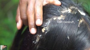 Psoriasis treatment - Big Flakes, Dandruff Scratching #139