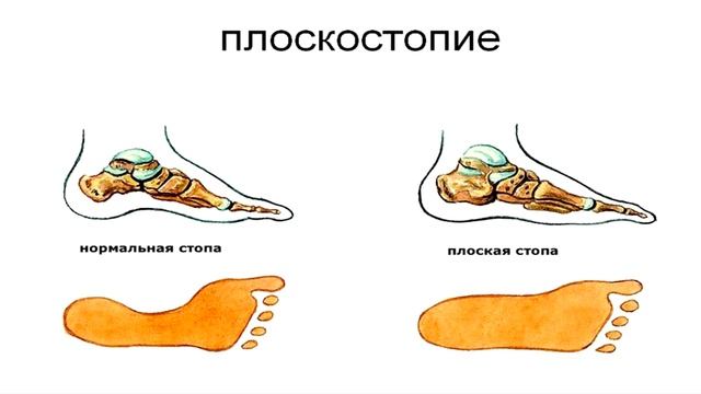 ПОЧЕМУ С ПЛОСКОСТОПИЕМ НЕ БЕРУТ В АРМИЮ ? смотреть онлайн