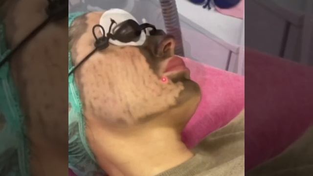 Карбоновый пилинг смотреть онлайн