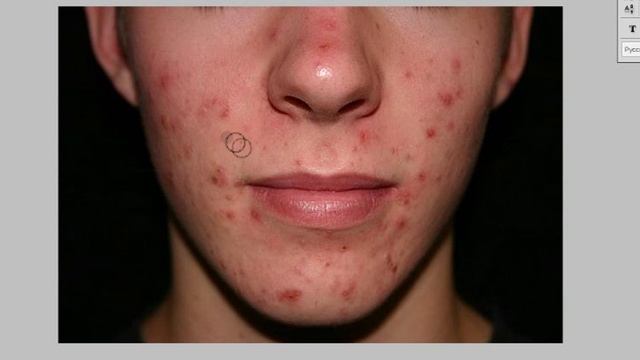 [Урок] Как убрать прыщи, родинки и д.р в Photoshop смотреть онлайн