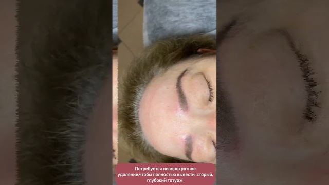 Удаление татуажа ремувером смотреть онлайн