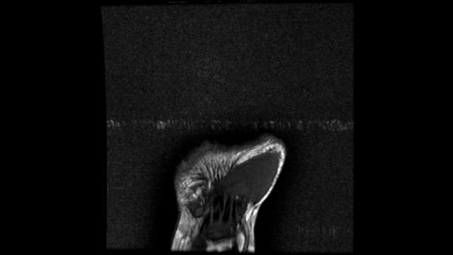 Time-resolved magnetic resonance angiography in a case of syndactyly at 3 Tesla смотреть онлайн