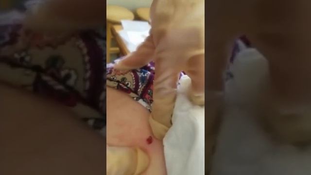 Amazing Popping huge blackheads and BEST Pimple Popping TIKTOK Videos Compilation #2 смотреть онлайн