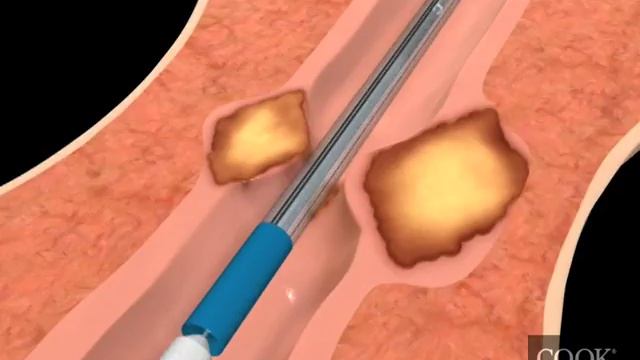 Evolution® Esophageal Controlled-Release Stent – Partially Covered Endoscopic Animation смотреть онлайн