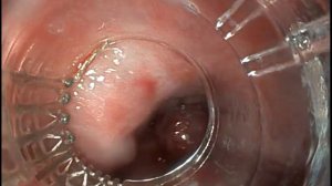 Лигирование варикозно расширенных вен пищевода.