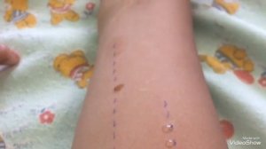 АЛЛЕГОПРОБЫ  ТЕСТ АЛЛЕРГЕНЫ КОЖНЫЕ ПРОБЫ АЛЛЕРГИЯ У ДЕТЕЙ  НА ПЫЛЬ КАК УЗНАТЬ НА ЧТО У ВАС АЛЛЕРГИЯ