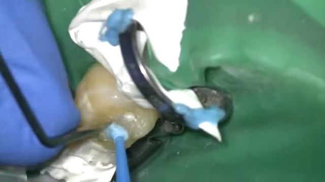 Фиксация накладки на 36 зуб смотреть онлайн