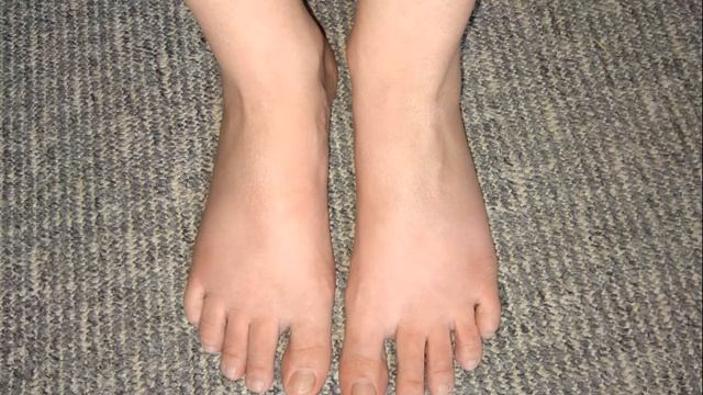 ОТЕКИ НИЖНИХ КОНЕЧНОСТЕЙ | Причины и лечение отеков