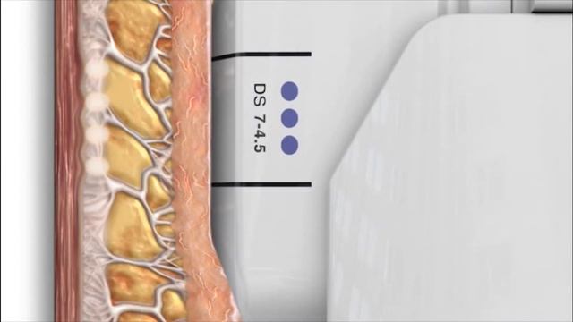 Ультразвуковой SMAS-лифтинг, подтяжка лица | Tulip Medicine | Астана смотреть онлайн