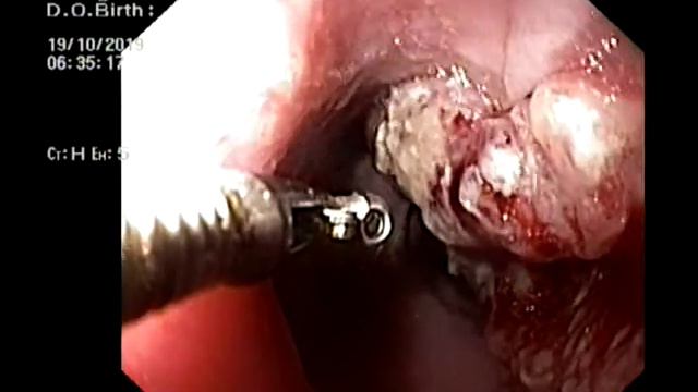 Qida borusunun törəməsi. Eroziyalı bulbit смотреть онлайн