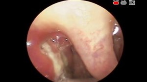 #Гнойная #ангина воспаление #Миндалин, глотки