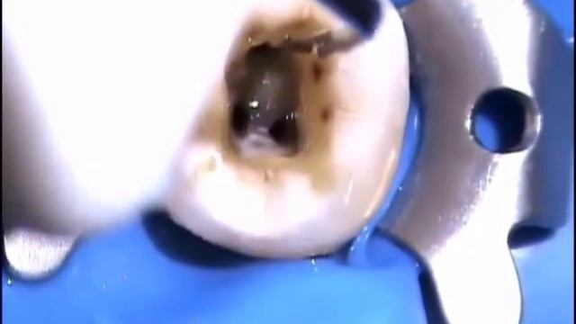 Endo-Irrigator Plus by Dr. Mandar Pimprikar смотреть онлайн