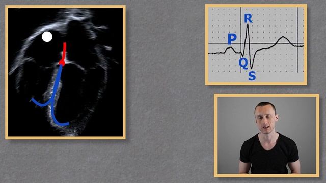 Миграция водителя ритма | ЭКГ смотреть онлайн