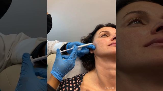 Radiesse Filler Treatment To The Mid-face/Cheeks