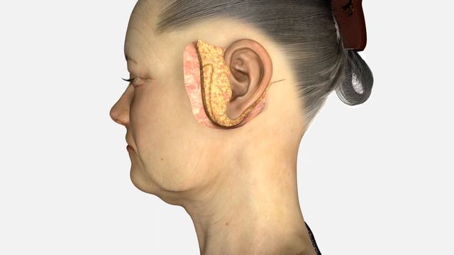 Facelift & Neck Lift surgery - Dr. Julian De Silva - 3D medical animation смотреть онлайн