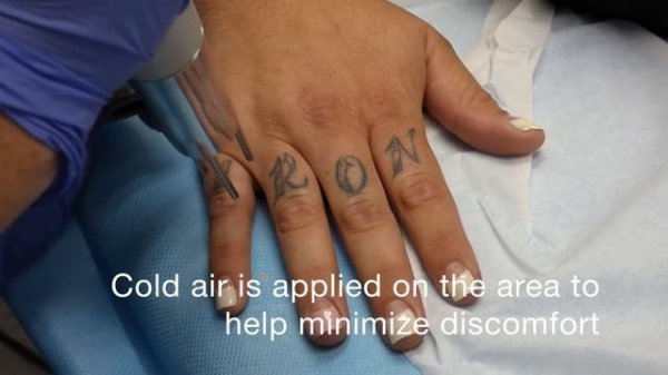 Tattoo Removal - Knuckle Tattoos at Dr. Tattoff Orange County