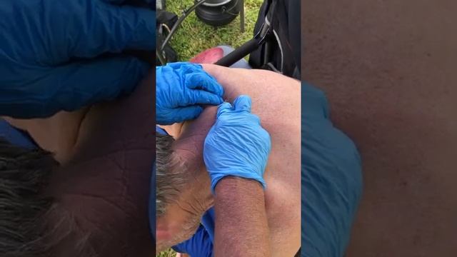 Cyst Explosion Pt 2 #exploding #pop  #popping