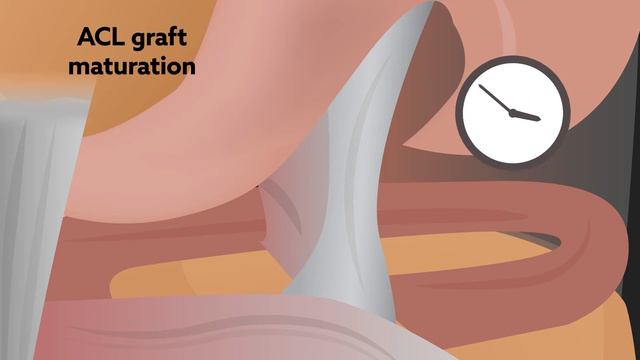 Objective assessment of ACL graft status after ACL reconstruction using T2* MRI смотреть онлайн