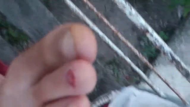 После удаления натоптыша и ногтя Получилось 4 шва смотреть онлайн