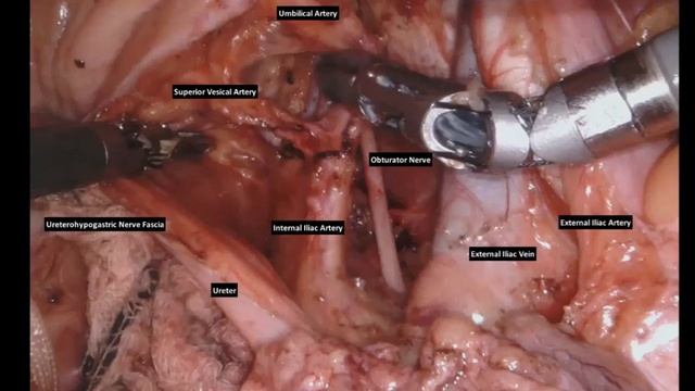 Easy way to understand lateral pelvic lymph node dissection (PLND) смотреть онлайн