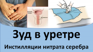 Зуд в уретре. Инстилляции нитрата серебра