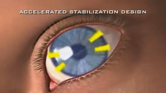 Положение астигматических ( торических) линз в глазу смотреть онлайн