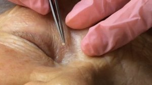 Удаление милиума