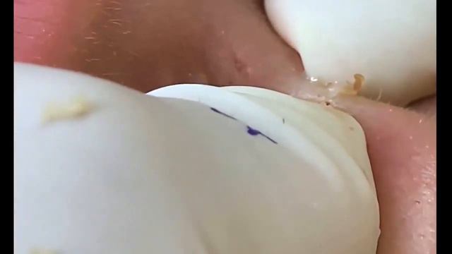 удаление прыщей , очистка лица смотреть онлайн