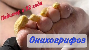 Онихогрифоз _ грибок ногтей _ педикюр на выезде