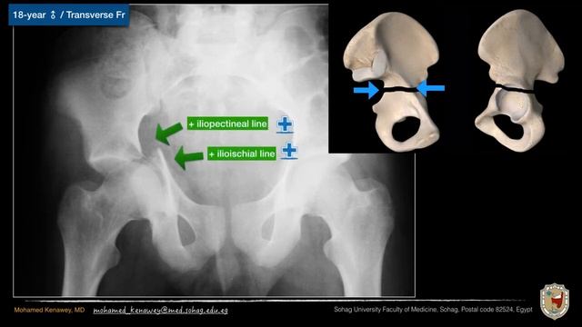 The Five-Point Radiographic System for Classifying Acetabular Fractures and Basics of Management смотреть онлайн