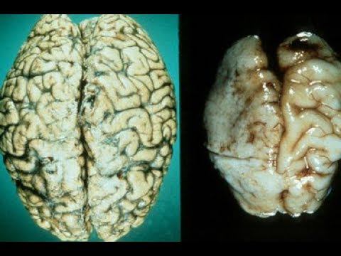 Алкоголь Продолжает Разрушать Мозг Даже Если Бросили Пить смотреть онлайн