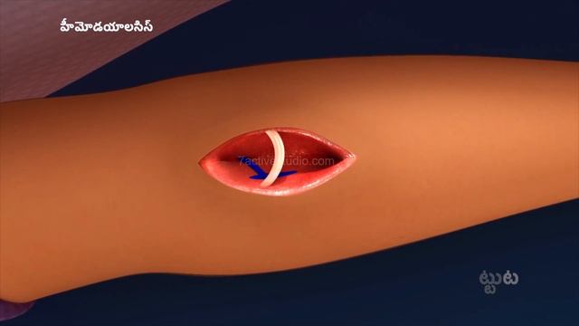 #DIALYSIS | Telugu смотреть онлайн