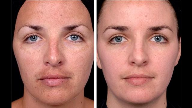 Гликолевый пилинг смотреть онлайн