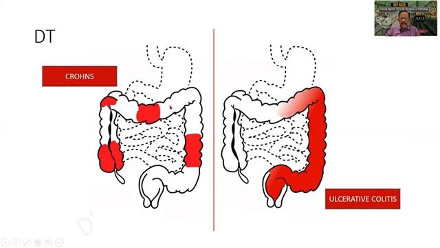 Inflammatory Bowel Disease - GIT - R.A.T.S in Pathology - University questions - Dr G Shivashekar смотреть онлайн