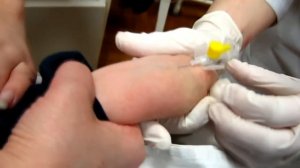 Катетеризация периферических вен у детей