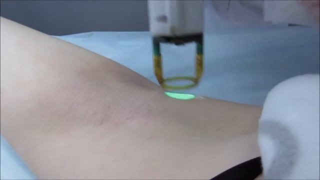 Лазерная эпиляция подмышек смотреть онлайн